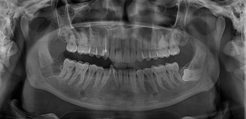 How are Impacted Wisdom Teeth Treated? laser-dentistry