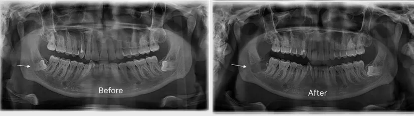 Painless Wisdom Tooth Extraction painless-wisdom-tooth-extraction