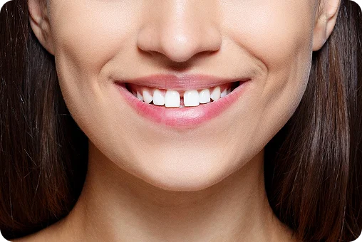 Teeth Gap