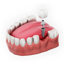 Single Tooth